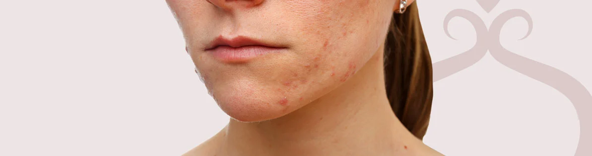 Correção de Cicatrizes de Acne Imagem Correção de Cicatrizes de Acne