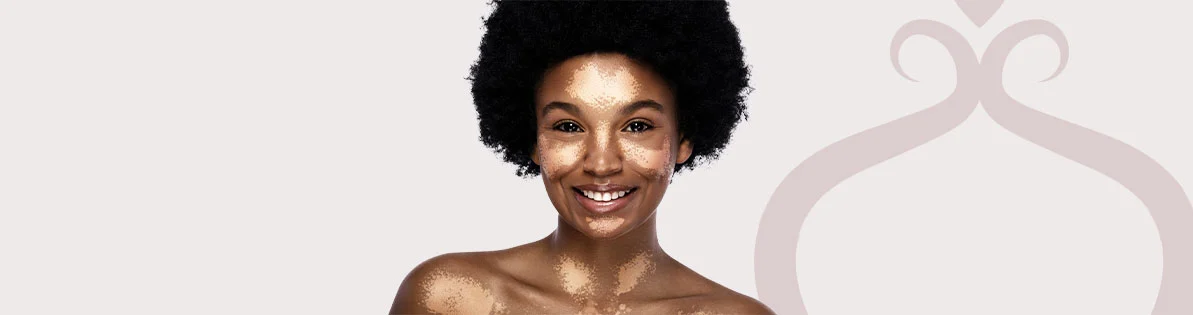 Vitiligo Imagem Vitiligo