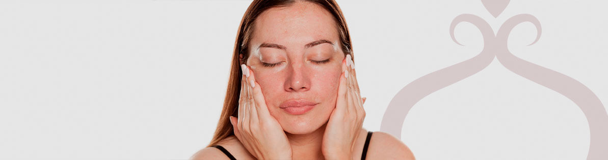Melasma Imagem Melasma