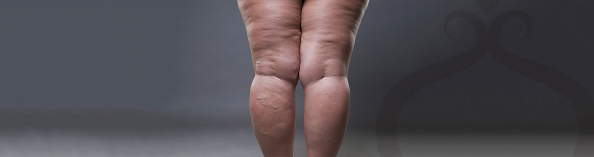 Ácido Poli L Láctico Imagem-interna-Lipedema-Vanessa-Barcellos