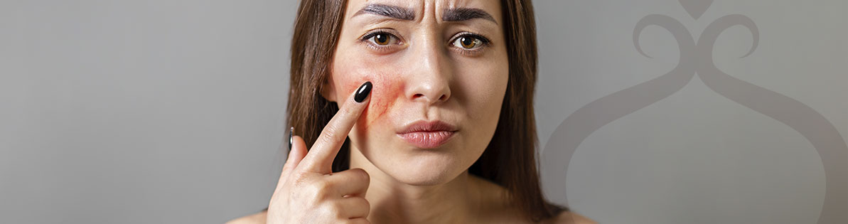 Ácido Poli L Láctico Imagem-interna-rosacea-Vanessa-Barcellos